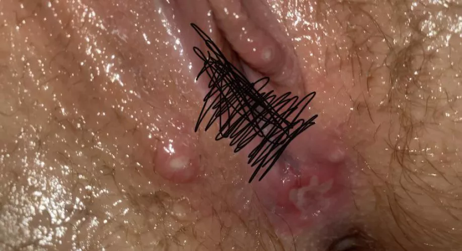 cyst or pimple? if so, i have the urge to pop them, very painful to touch though. NSFW by SugaranimationsWTF