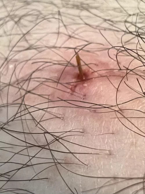 Pushed out another leg splinter today. Was very painful for a few days. by binybeke