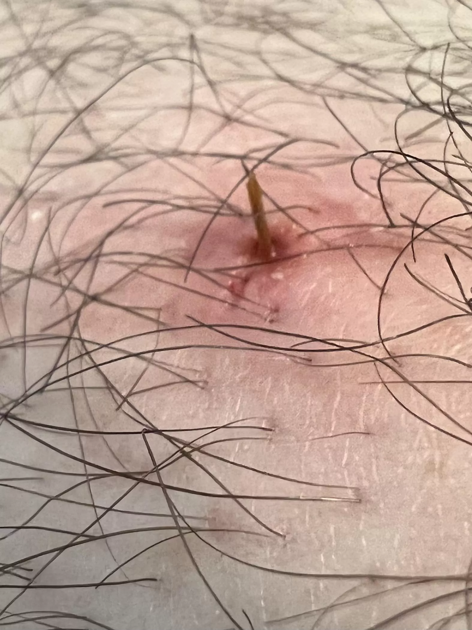 Pushed out another leg splinter today. Was very painful for a few days. posted by binybeke