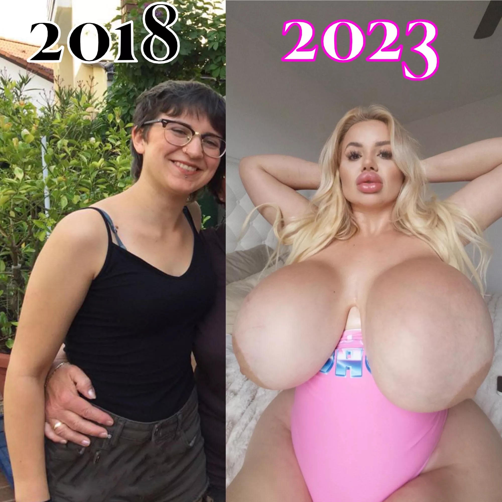 Updated Transformation After Her Second BBL posted by KaylaDecay