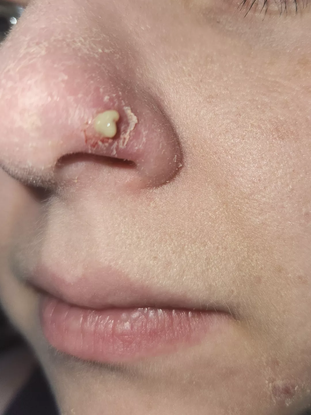 Update on my little nose friend. It was Staph. It also popped on it's own when I blew my nose 😭 posted by quietmania