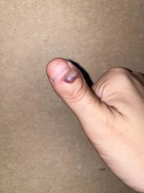 It’s my Megan Fox thumb, she has so many struggles. Finally let a Dr do the freeze today. Must.. not.. pop…. by notyourslavebut