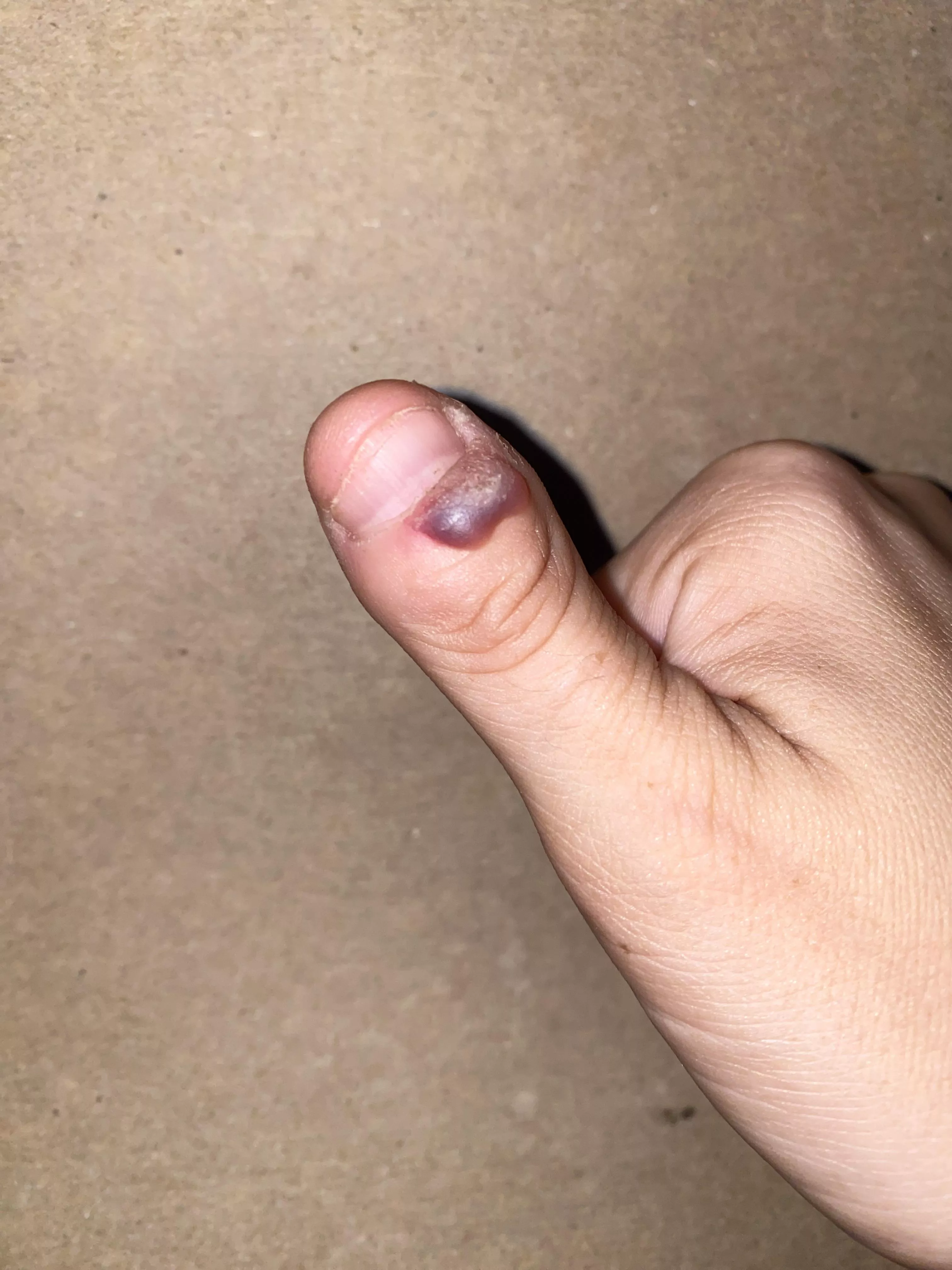 It’s my Megan Fox thumb, she has so many struggles. Finally let a Dr do the freeze today. Must.. not.. pop…. posted by notyourslavebut