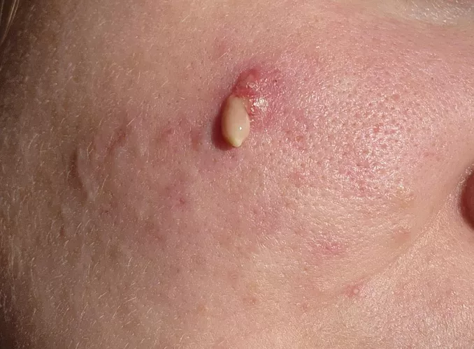 I've been fighting this fucker for over a year. With the help of a dermatologist (this is the third time it's popped,) I think it may finally be passing. by happuning