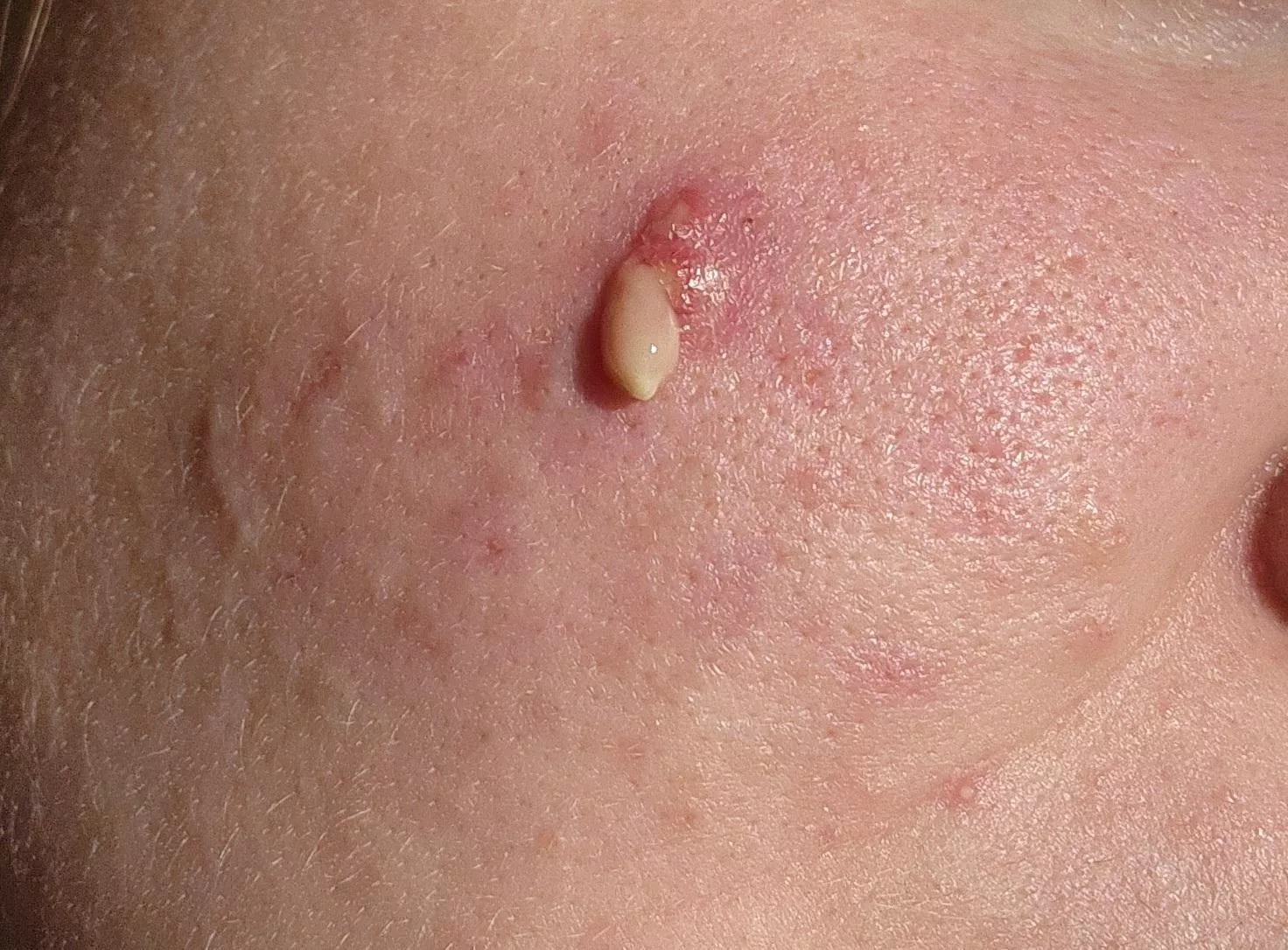 I've been fighting this fucker for over a year. With the help of a dermatologist (this is the third time it's popped,) I think it may finally be passing. posted by happuning