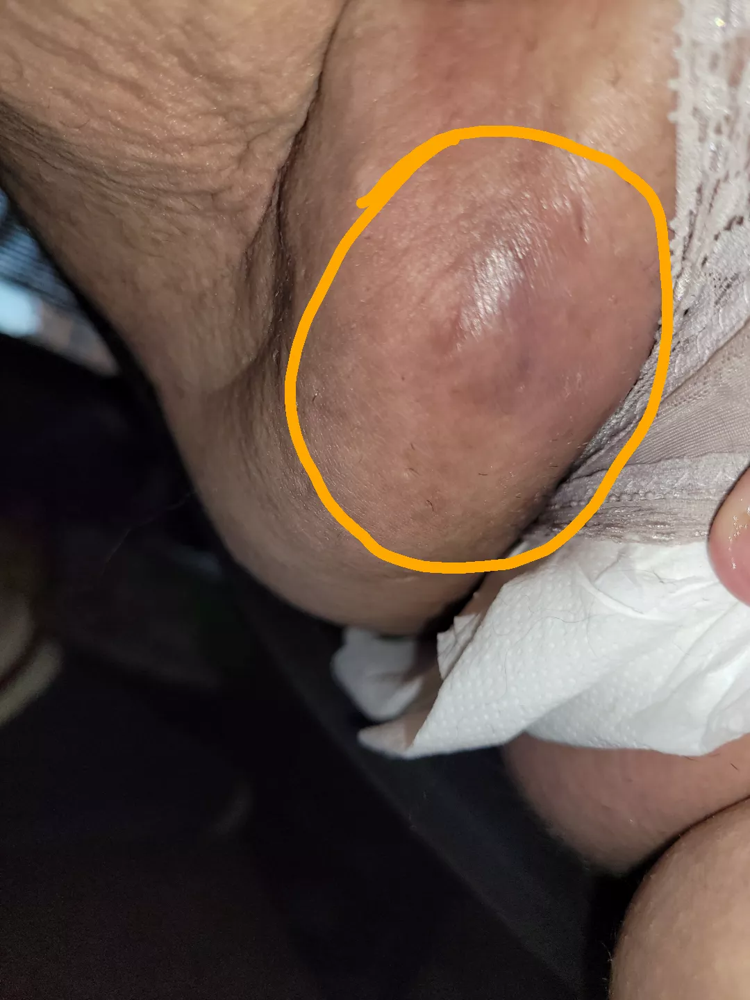 Large strep b boil/abcess on vagina. It has ruptured on its own and I am on medicine to get rid of the infection. It was caused by a high blood sugar for a prolonged period of time. posted by Little_Enby_Bean_96