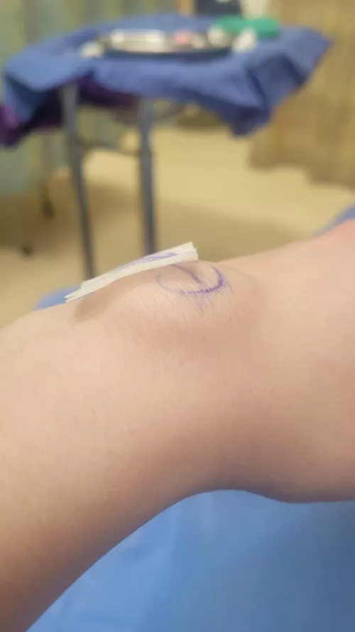 The surgeon numbed my wrist for a cyst removal and the freezing created a huge bubble under my skin. by Decent_Penalty7763