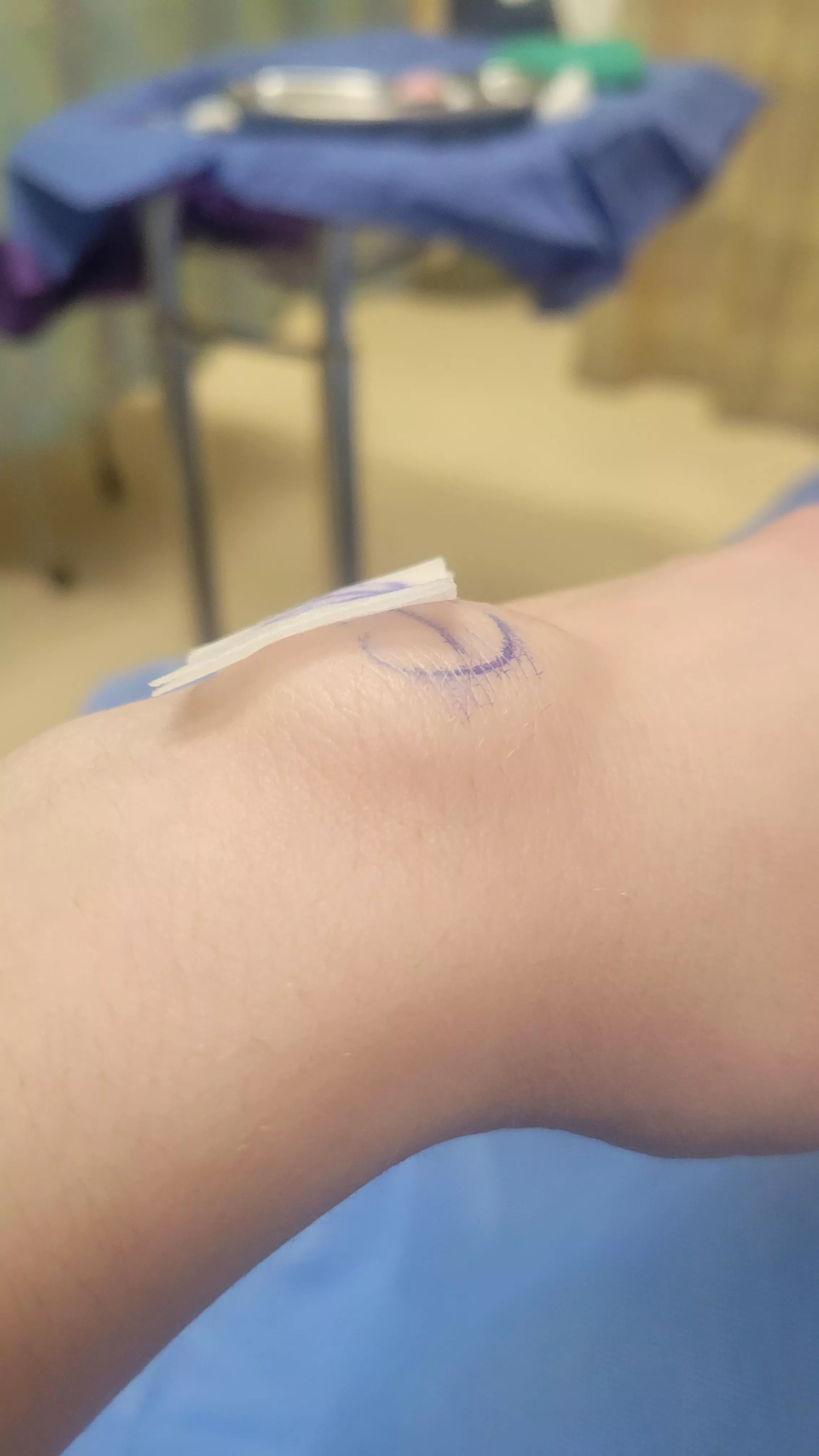 The surgeon numbed my wrist for a cyst removal and the freezing created a huge bubble under my skin. posted by Decent_Penalty7763