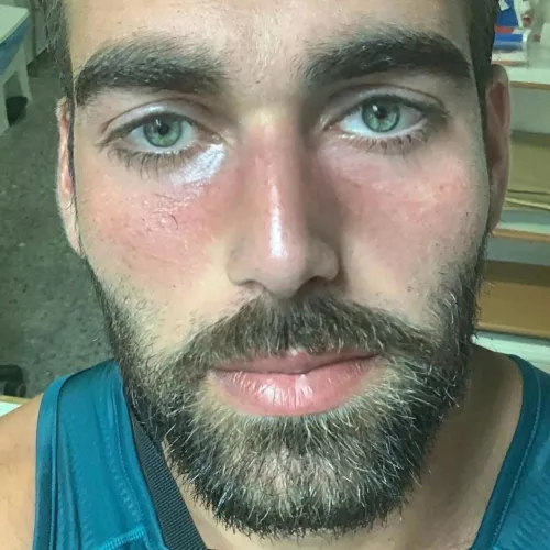 Rosacea flare-up. I struggled with this for years and am still struggling. by Lorenzo7891