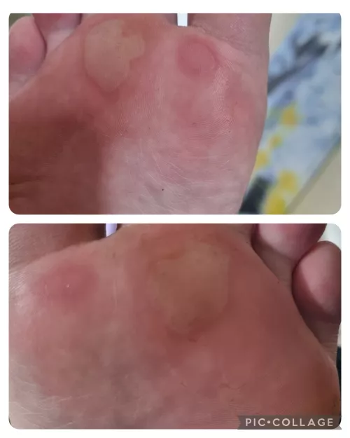 Went for a long walk in sandals the other day at 33 weeks pregnant, like a fool. Now I have these fun blisters by winterberryowl