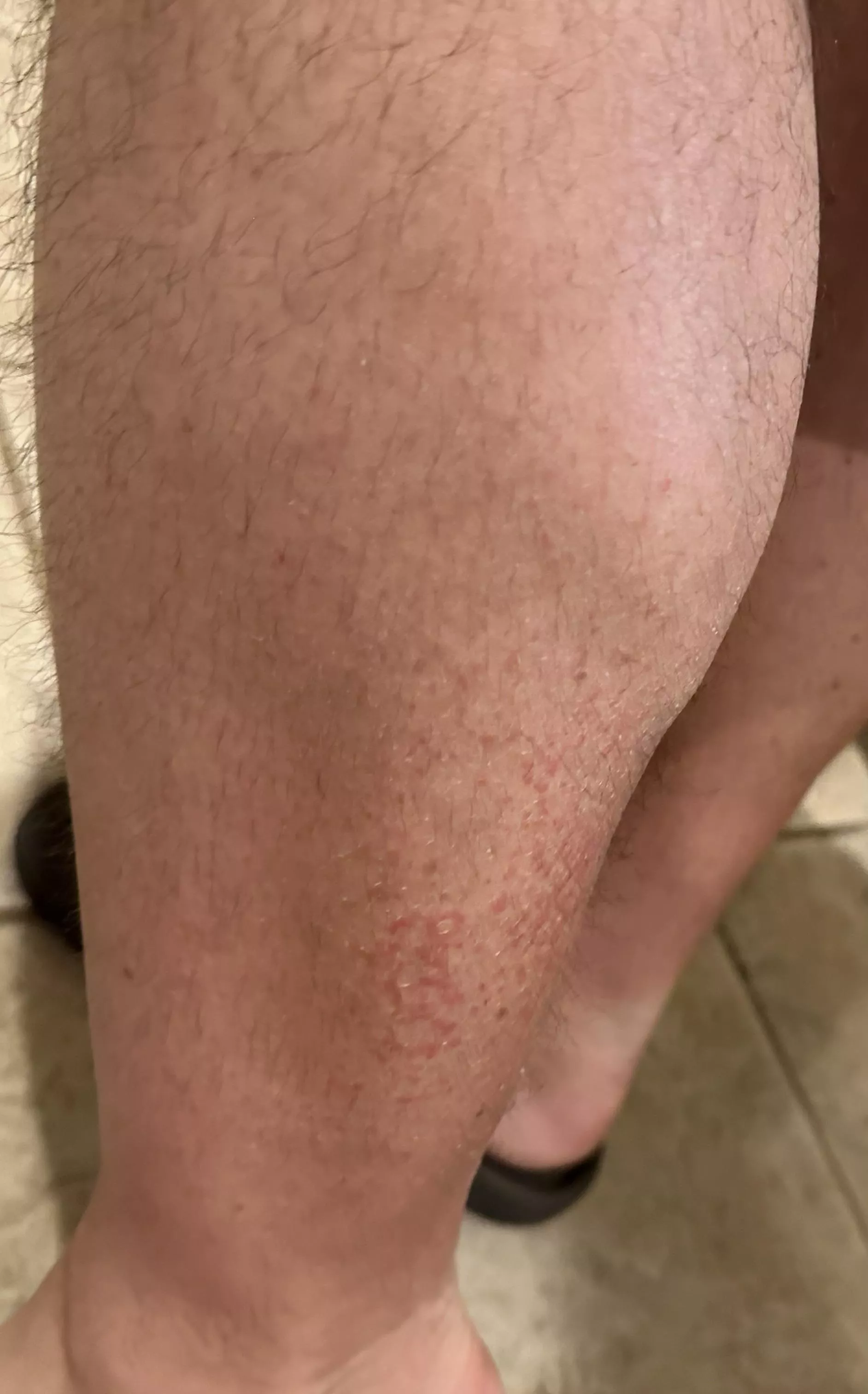 What I thought was eczema is actually cellulitis, so no popping or scratching posted by thediamondguest
