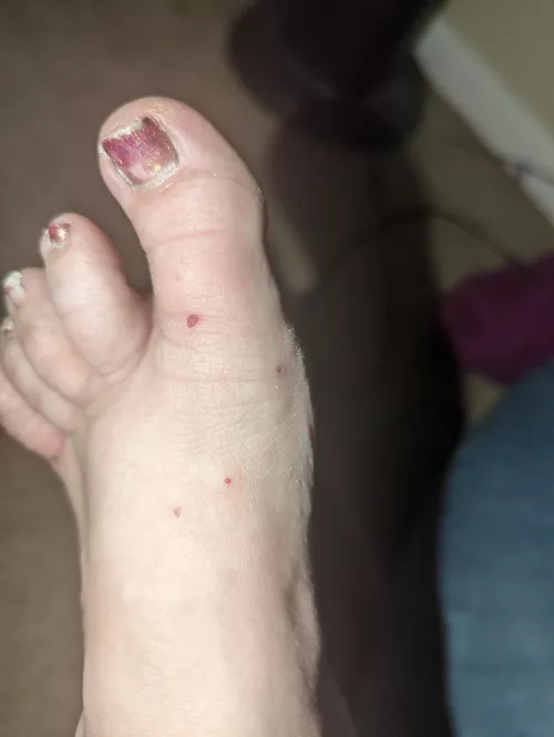 Forbidden pops. Fire ant bits. I'm allergic so my toe is swollen too. by Hobbit_toes76