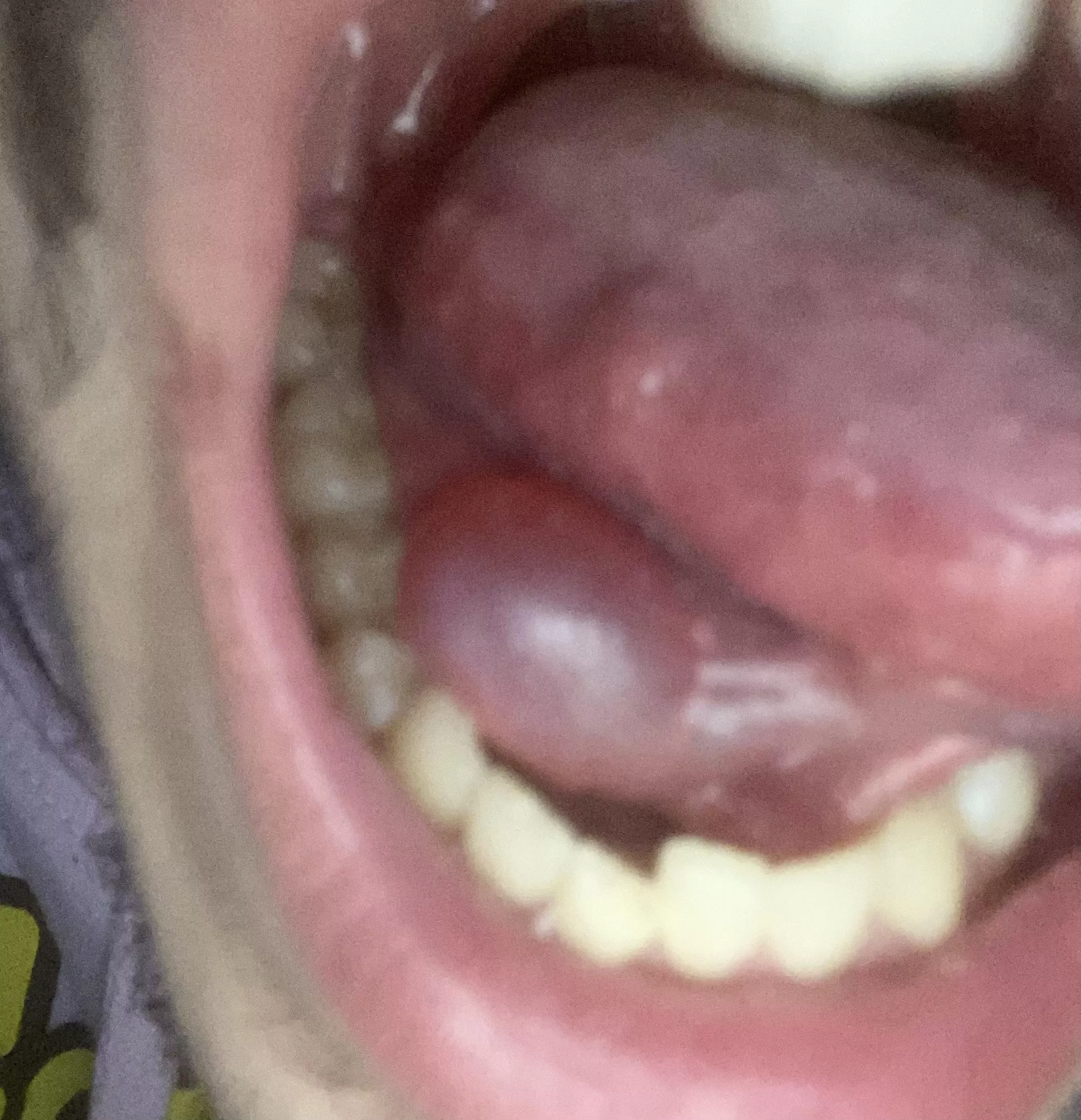 Bubble under my tongue posted by mycomunchy