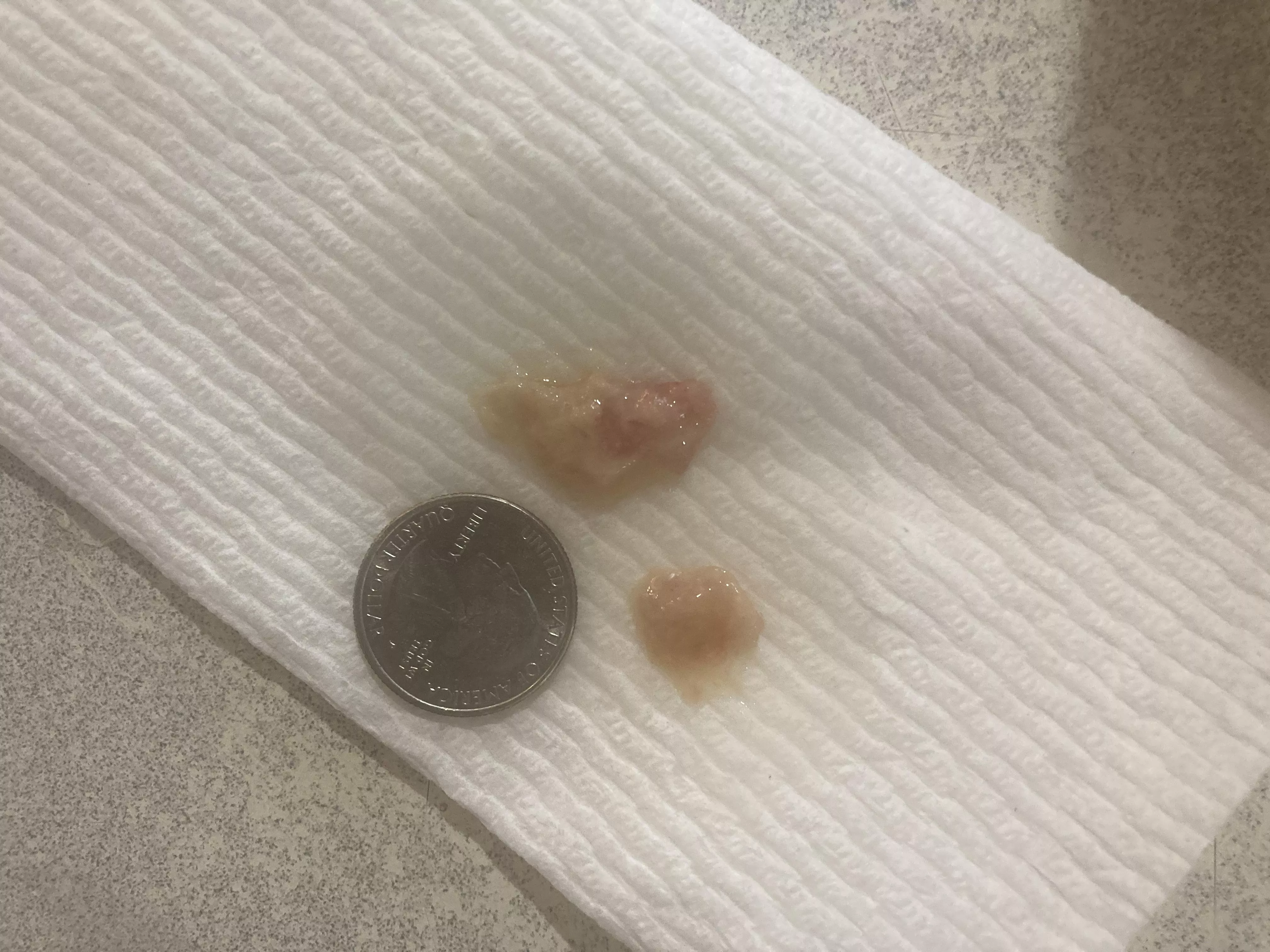 This came out of my sinuses this morning - no clue what it is. posted by Rose_Rose_Rose1