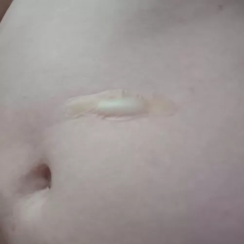 using a hydrocolloid patch for its intended purpose: testing burns by Warm-Branch