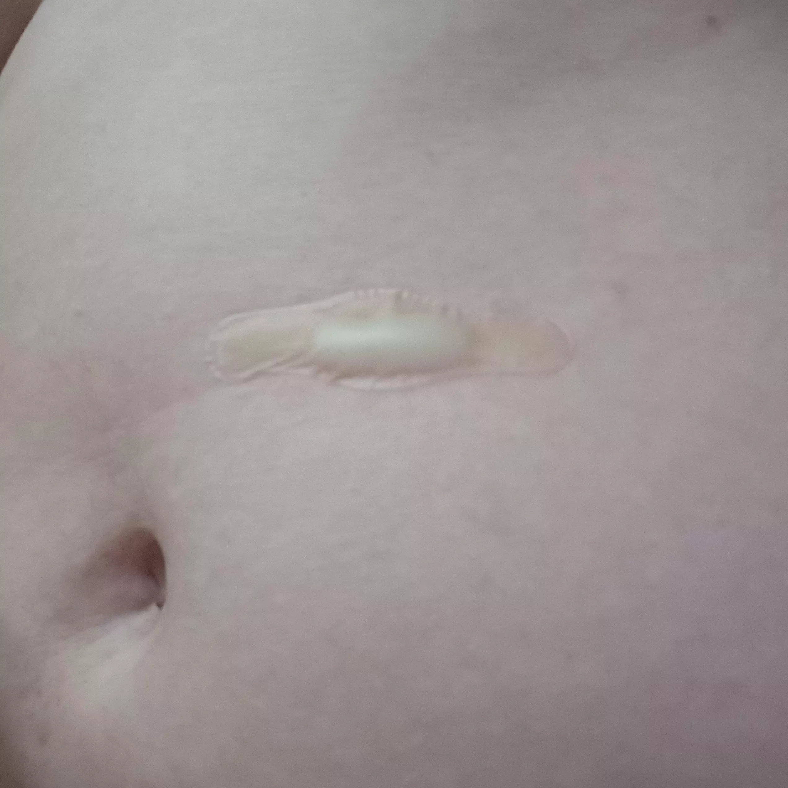 using a hydrocolloid patch for its intended purpose: testing burns posted by Warm-Branch