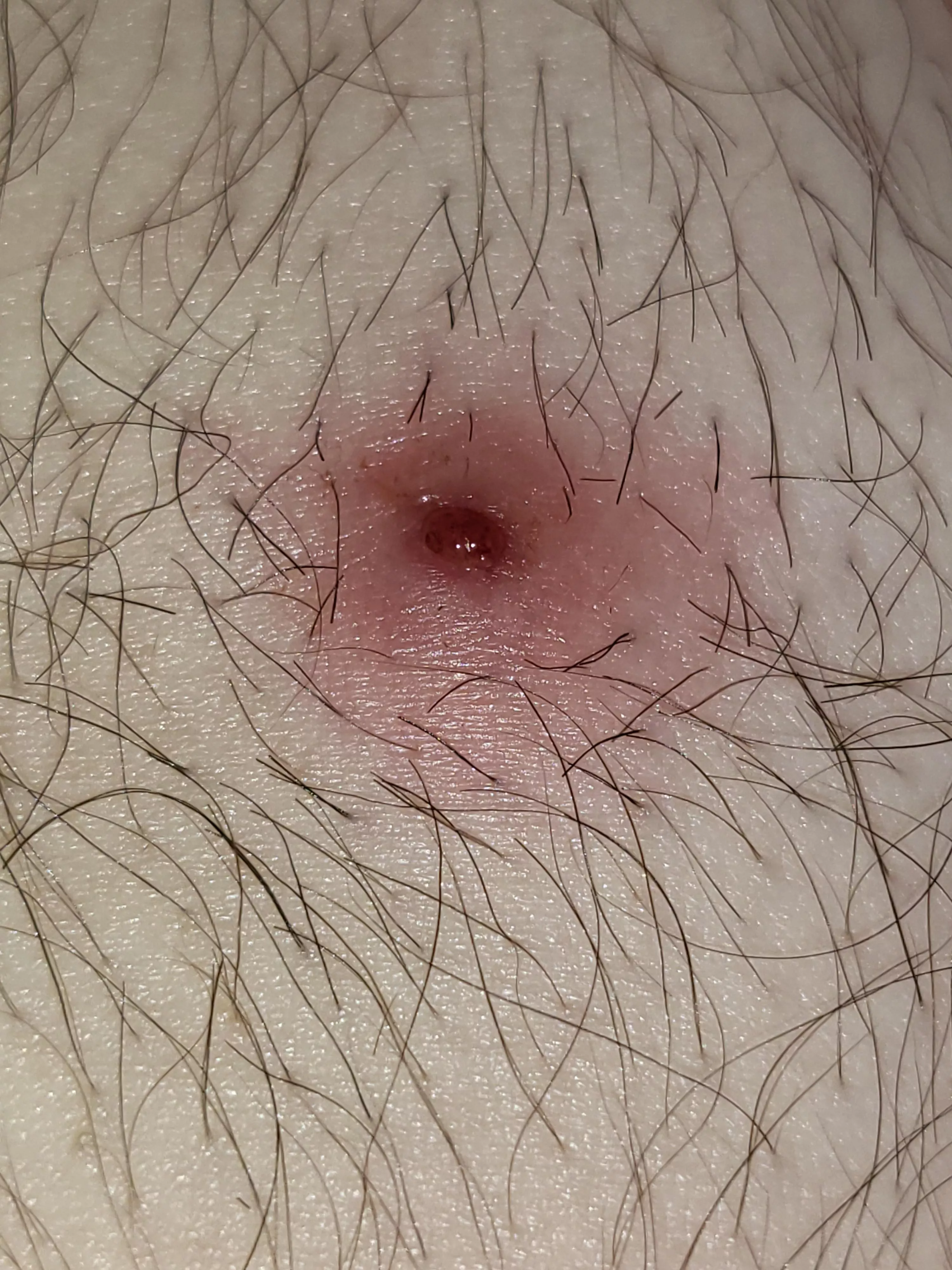 Cyst finally drained while in the shower without my seeming to have to do anything. Have questions. posted by HypatiaRising