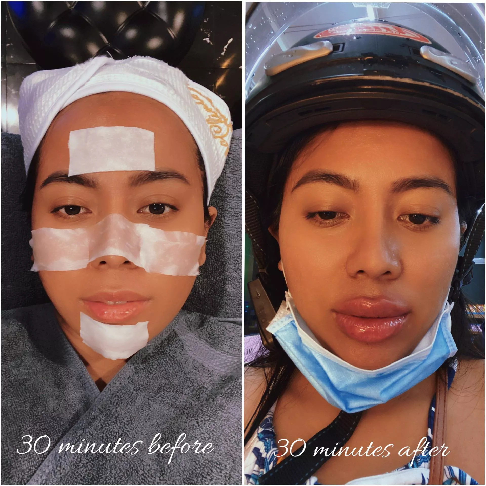 I just had a lip filler done sponsored by a generous, hot daddy! I’m gonna take lots of photos and videos all dolled up, but I just wanna share this now (I’m that excited!) How do my new bimbo lips look? I had a facial before the procedure (not the k posted by AsiaMorena