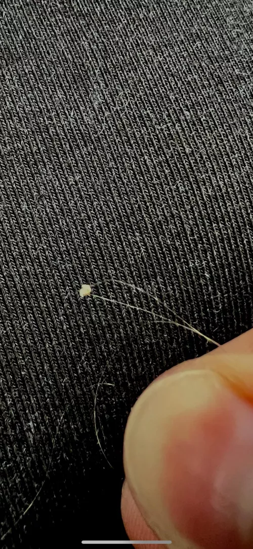 Deep cystic sit i’ve been digging my at in back of my head for 2.5 weeks by harbulary_Batteries_