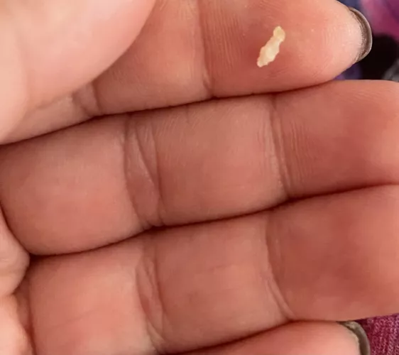 This came out of my scalp by nicksbrunchattiffany