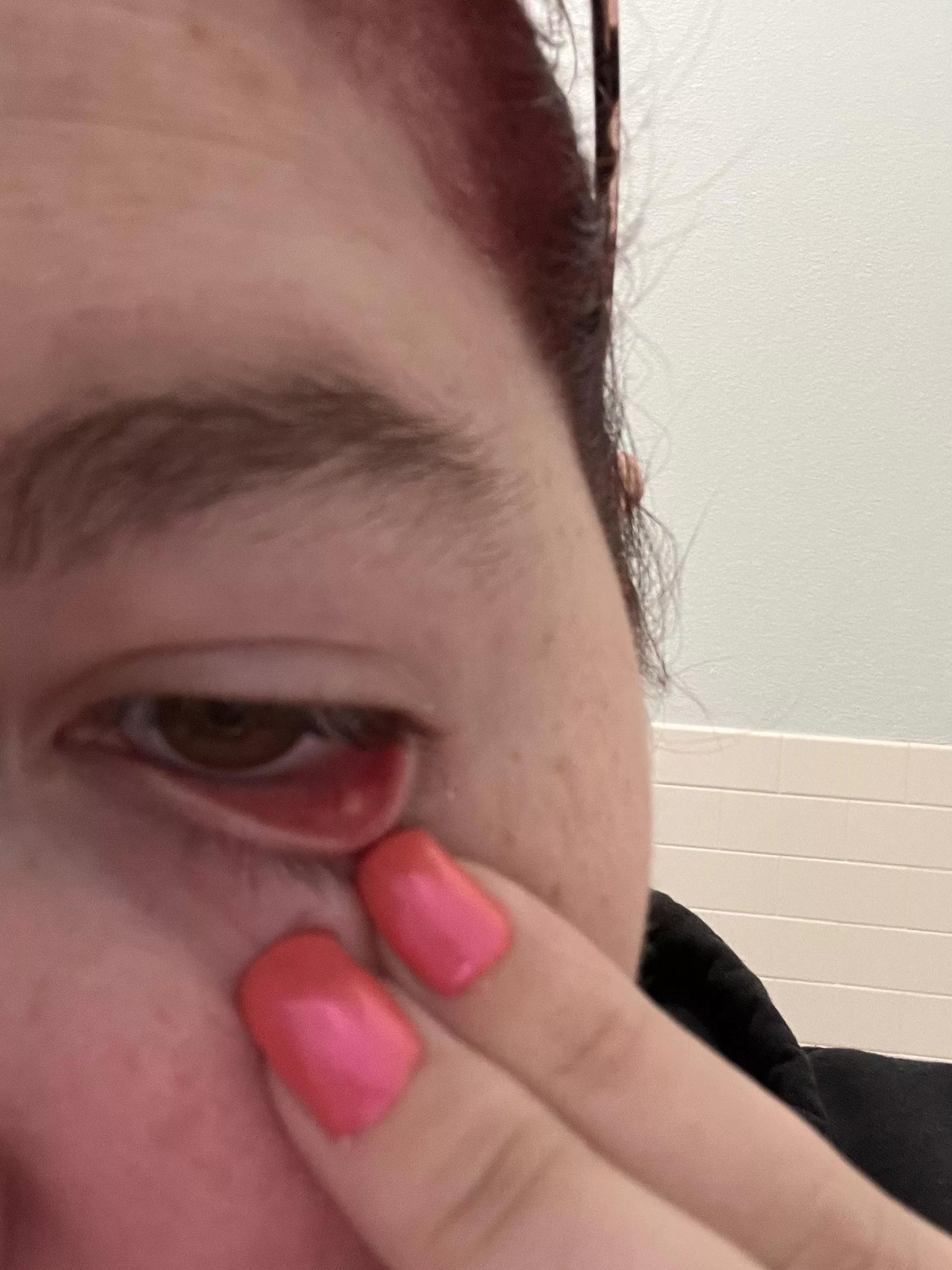 Forbidden pop in my left eye. Not sure what it is. It’s slightly larger today but not much so I’m giving it a couple of days to see what happens before I go to the doctor. posted by KaylaRocksss