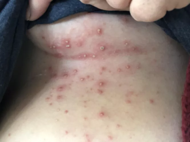 A heat rash that I let get a little out of control by MagicManicPanic