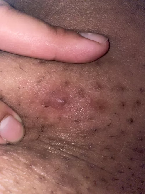 I’ve been trying to pop this angry dude on the inside of my thigh since yesterday and it’s being stubborn :( by SleepyAlium