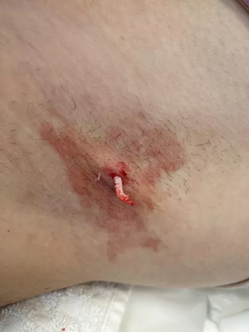 Armpit Cyst Big Daddy & Baby Pop by Chance_Philosophy17