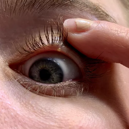 Forbidden pop on the waterline of my eyelid by fudgems16