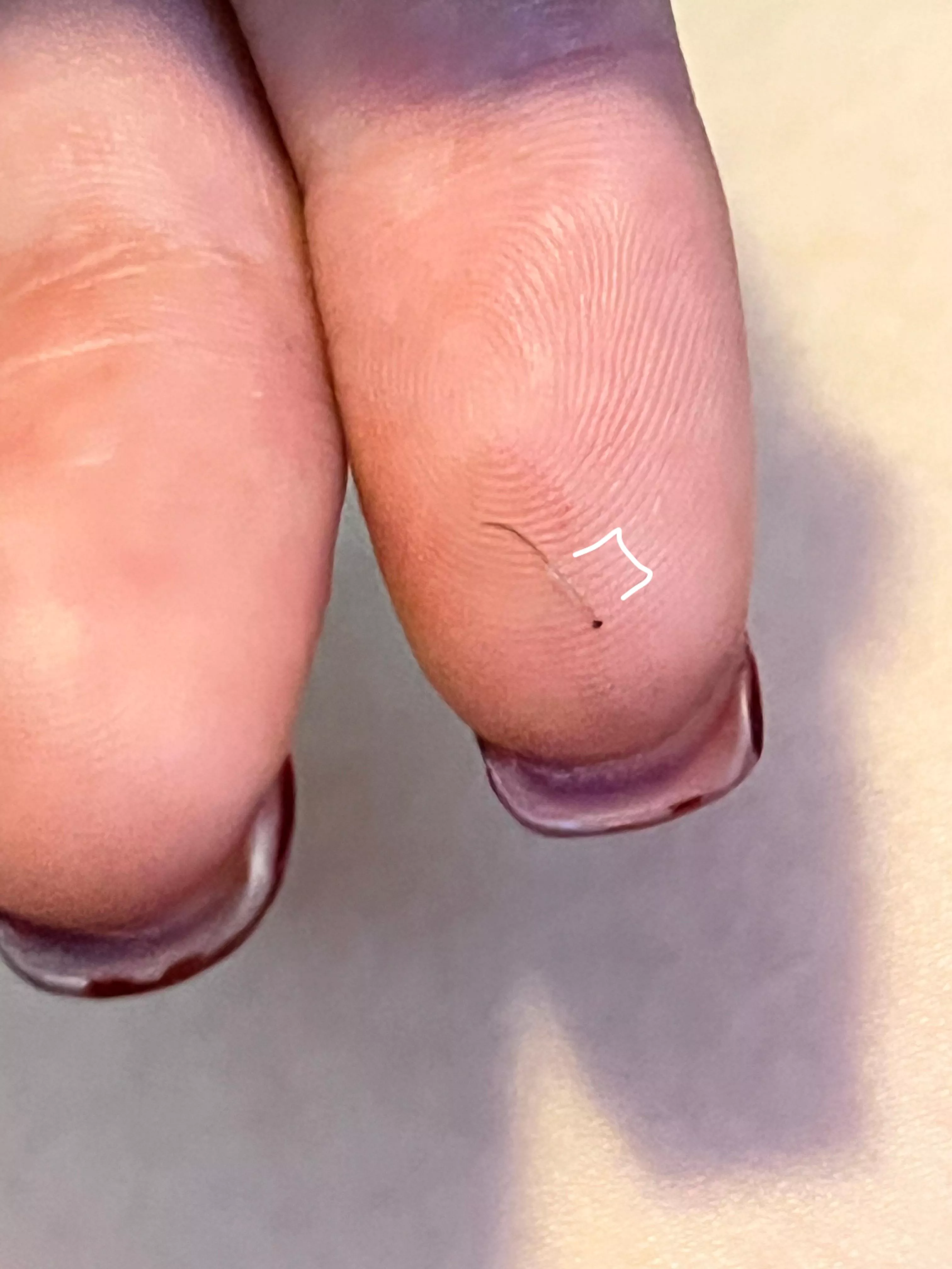 This hair I just plucked and the follicle on it posted by Becca_jammin