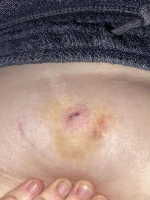 This lump appeared on my tummy in a stretch mark a few days ago and now has a dark line in it that looks like blood. Not sure what it is or why it’s started to bruise as I e tried to leave it alone. by LumpyJellyCat
