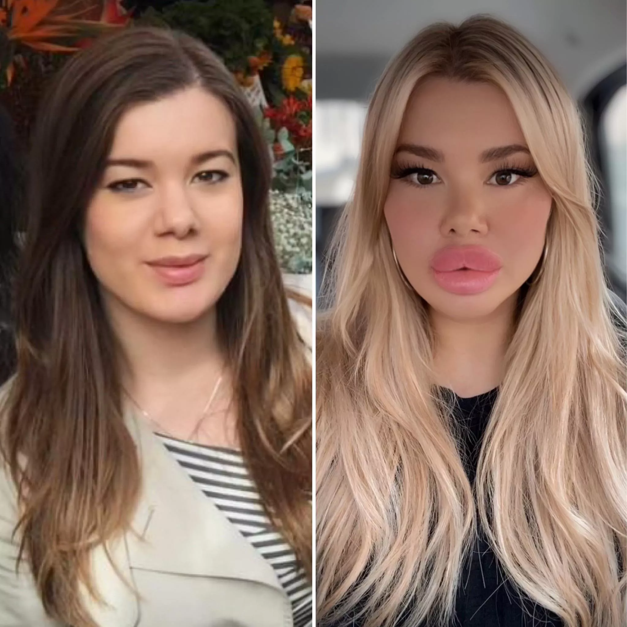 Before after lip fillers posted by Itsdollymix