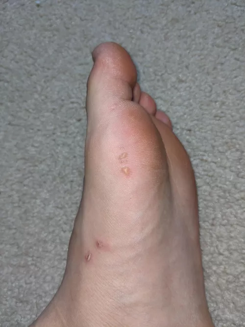 Clear sacs on my foot (not itchy but sensitive to touch) by Resident_Watch1048