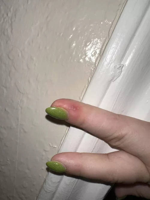 More herpetic Whitlow by Wicked_Weakness