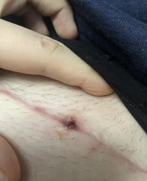 My inflamed C-Section wound, wish I would have recorded it, but I didn’t see it until it popped 🫣 by Top_Presentation3297