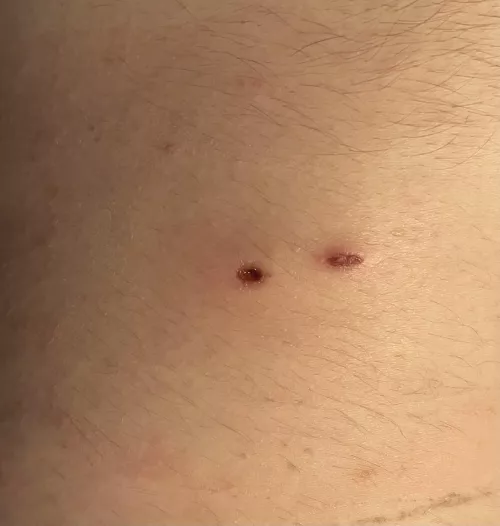 The hole my infected cyst left after getting drained. Can’t decide if I should cover it or let it breathe. by chronicflavors