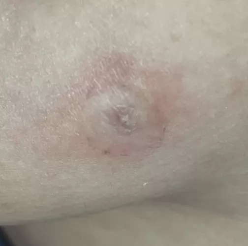 I wanna pop this so bad but I was taught not to pop pimples… by fzidoj