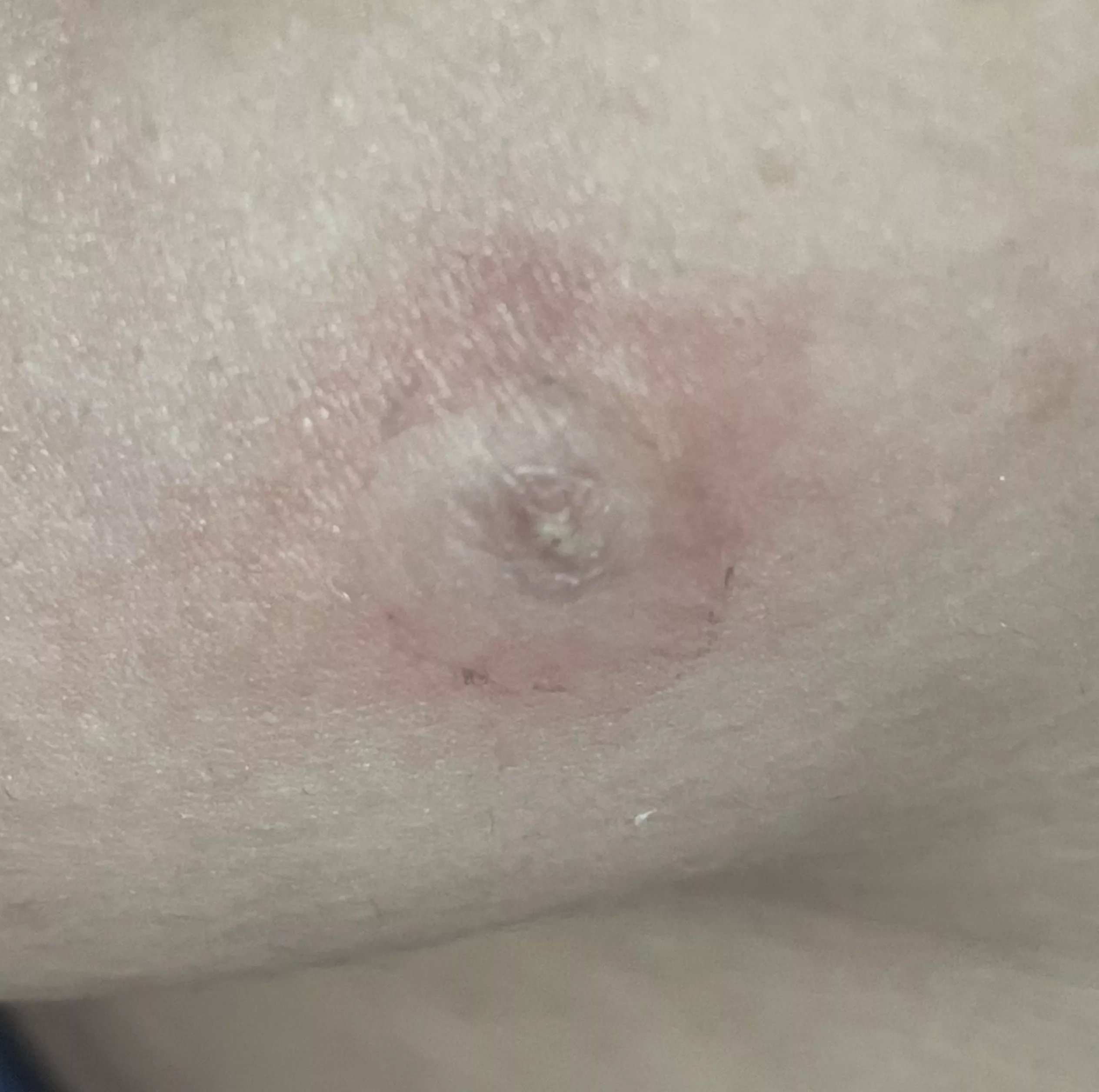 I wanna pop this so bad but I was taught not to pop pimples… posted by fzidoj