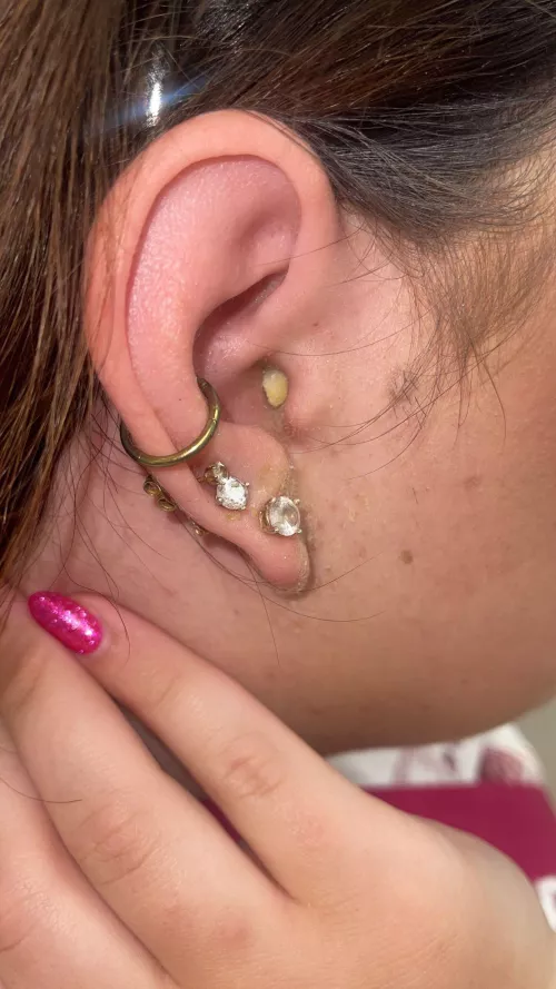 Ear infection! So painful by Internal_Vacation_72