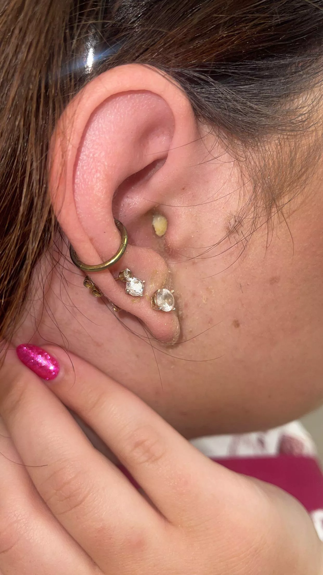 Ear infection! So painful posted by Internal_Vacation_72