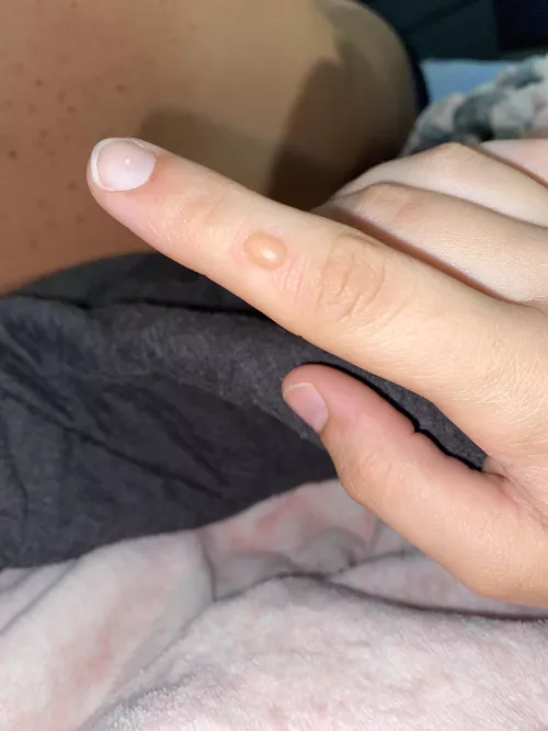 [pic] forbidden pop: blister from a grease burn on my finger 🥲 by ultravjolets