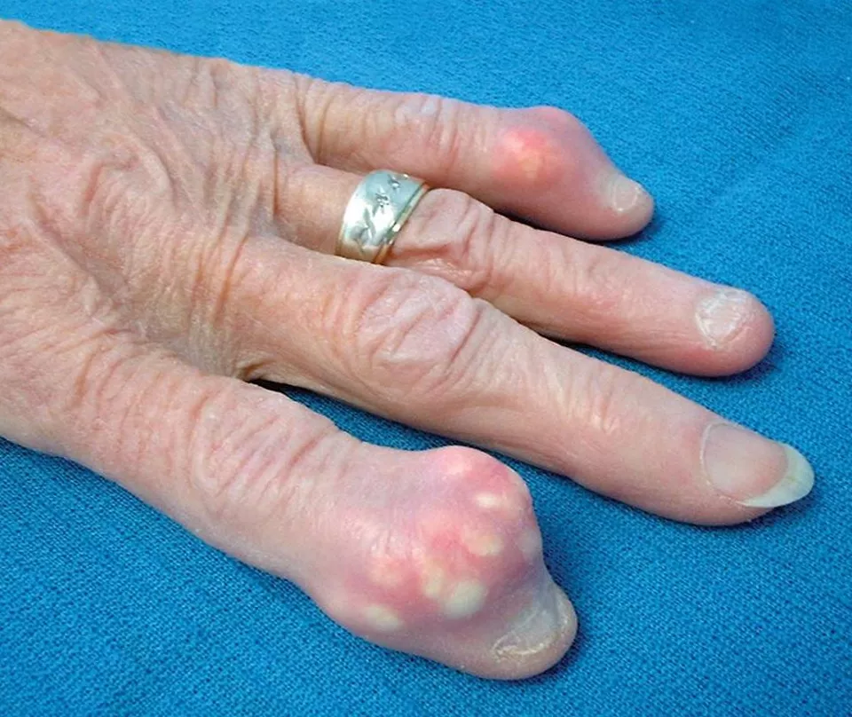 So is gout what we're getting into next? posted by conicDiestock798