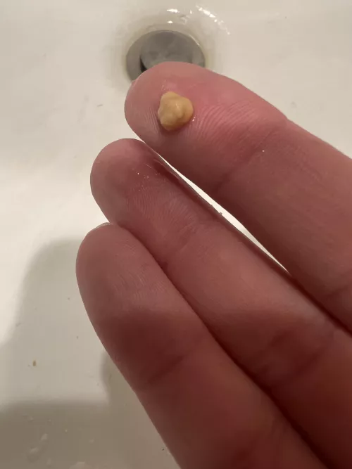 Biggest tonsil stone yet by SirliftStuff