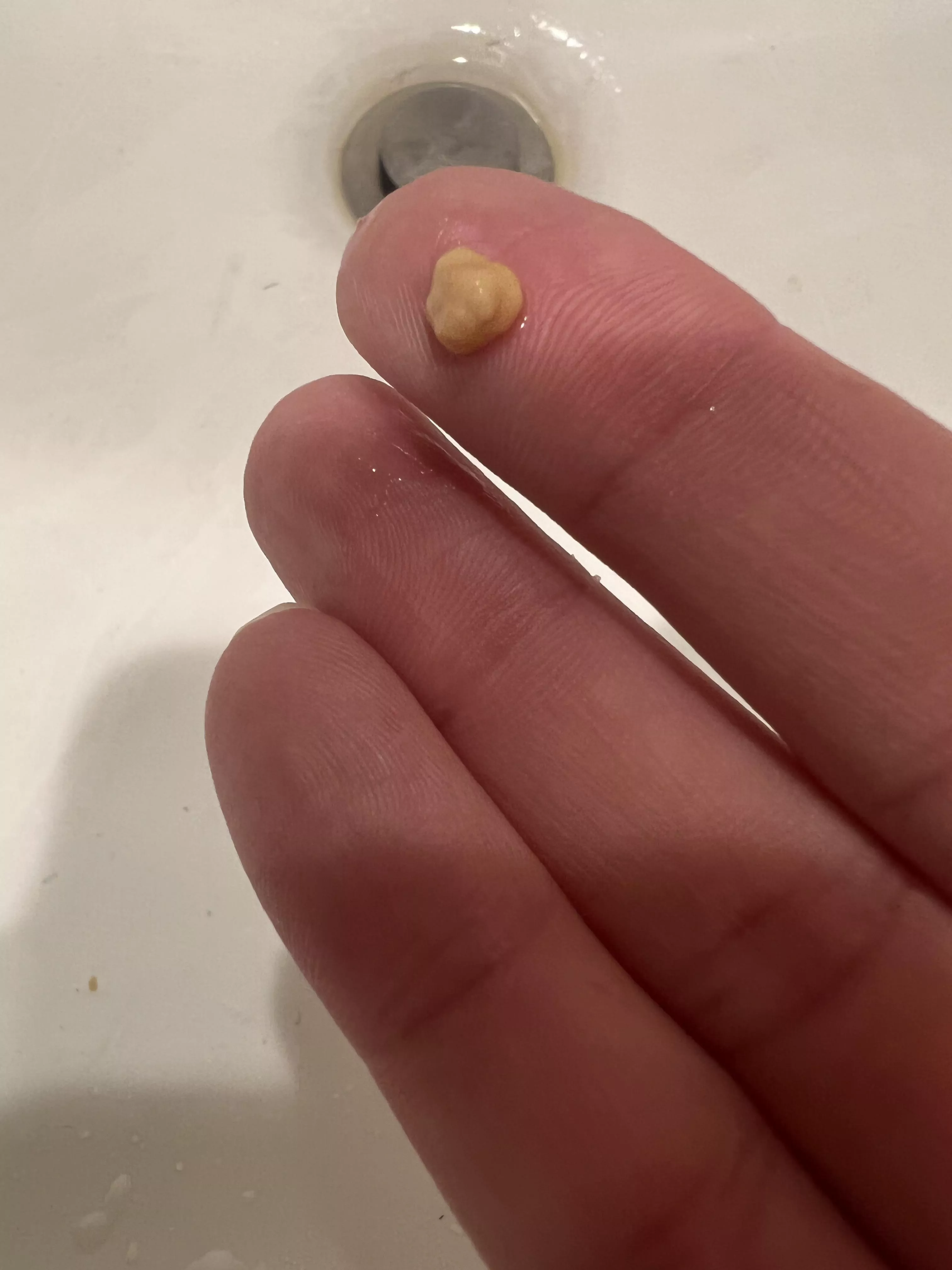 Biggest tonsil stone yet posted by SirliftStuff