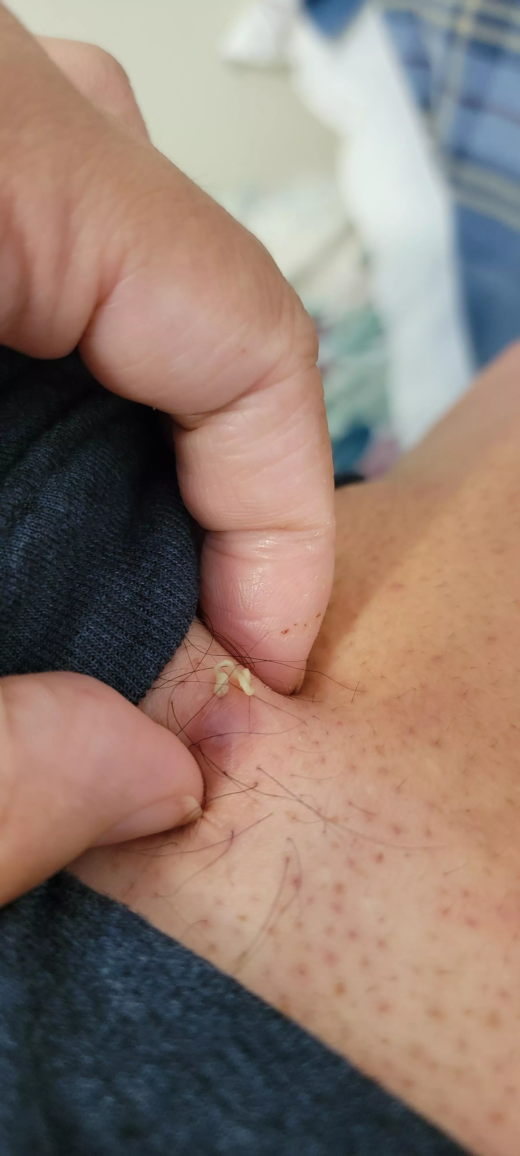 Had this cyst lanced 3 months ago. Girlfriend just gave it a squeeze again. 🤢 posted by Jinjahl