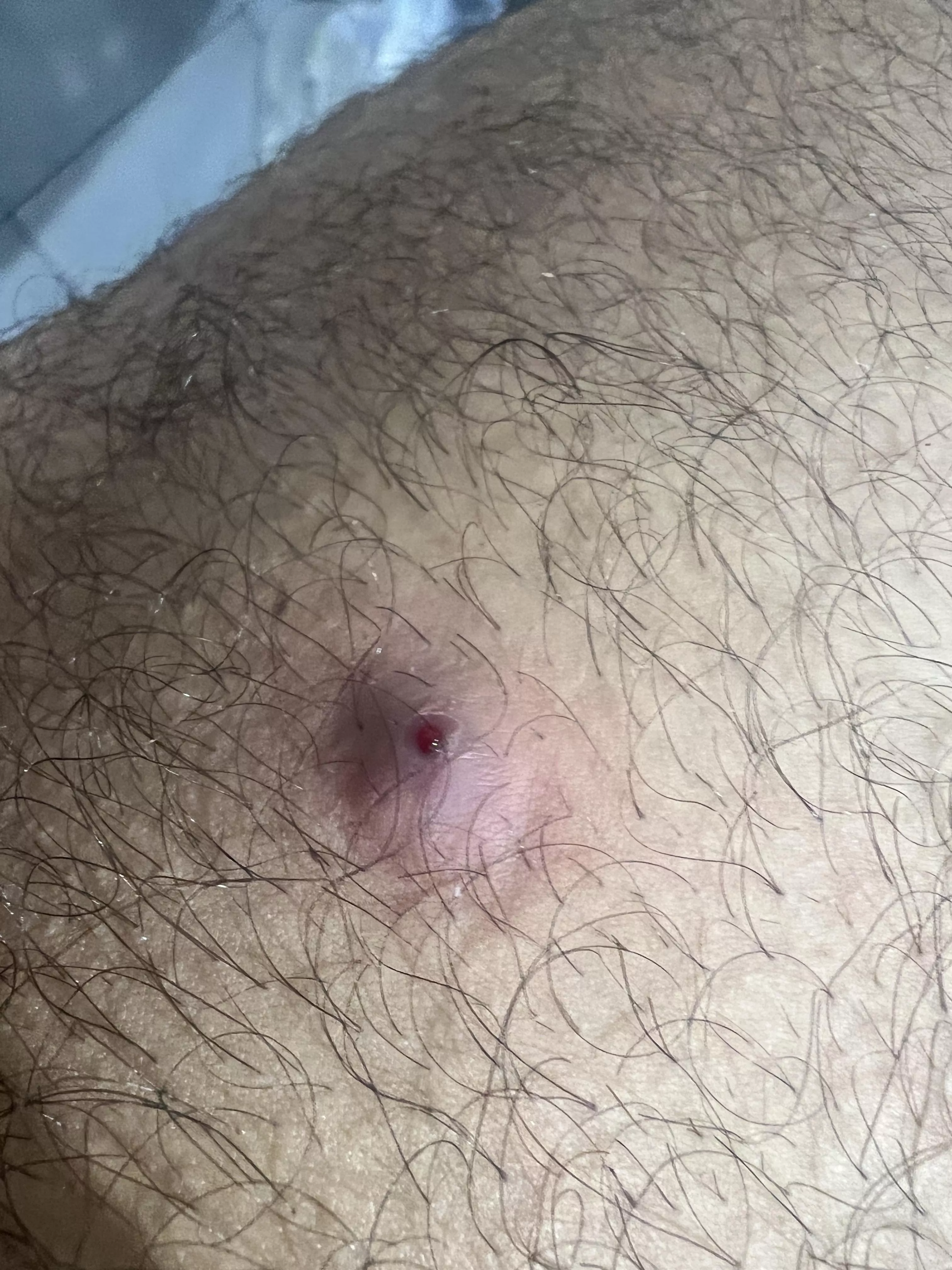 Pretty painful and have had this lump on my inner thigh for 5 days. Tried to pop with no success, just oozed blood. What could it be? posted by qasem01