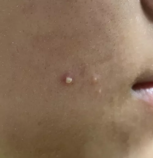 To pop or not to pop… by nope_rope_pasta