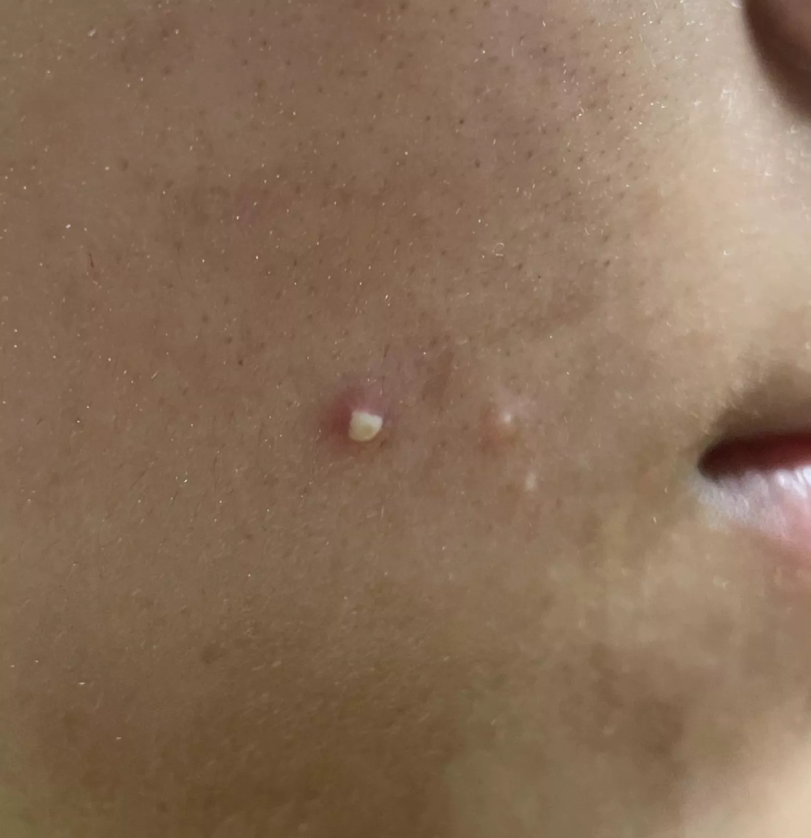 To pop or not to pop… posted by nope_rope_pasta