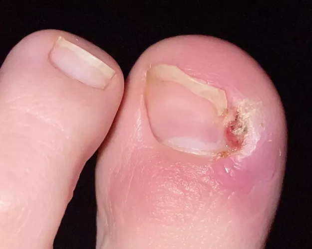 Update! Still waiting to see a podiatrist. The doctor I saw gave me antibiotics and said it’ll heal itself 😂 I guess I’ll do DIY surgery AGAIN. It’s still very sore and swollen so it’s really hard to dig out,but it does seem a bit better than  by makemeflyy