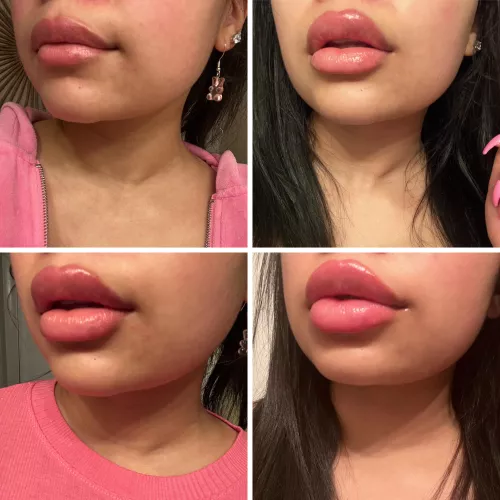 Got another syringe in my lips yesterday! Here’s the evolution of my lips over the past few months by xojustbri